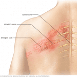 Why are so many COVID19 vaccinated people getting shingles?